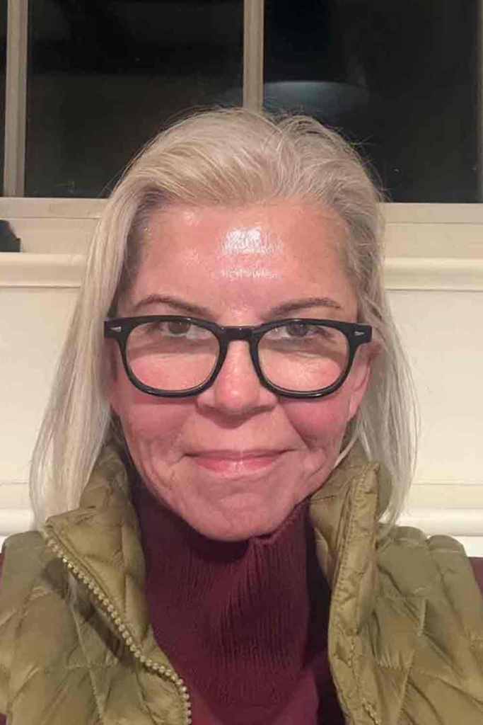 Cindy Hattersley TCA Chemical Peel Day 1