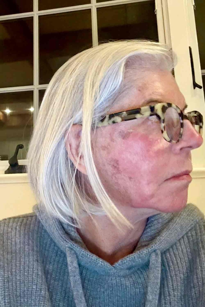cindy hattersley post TCA peel day 5